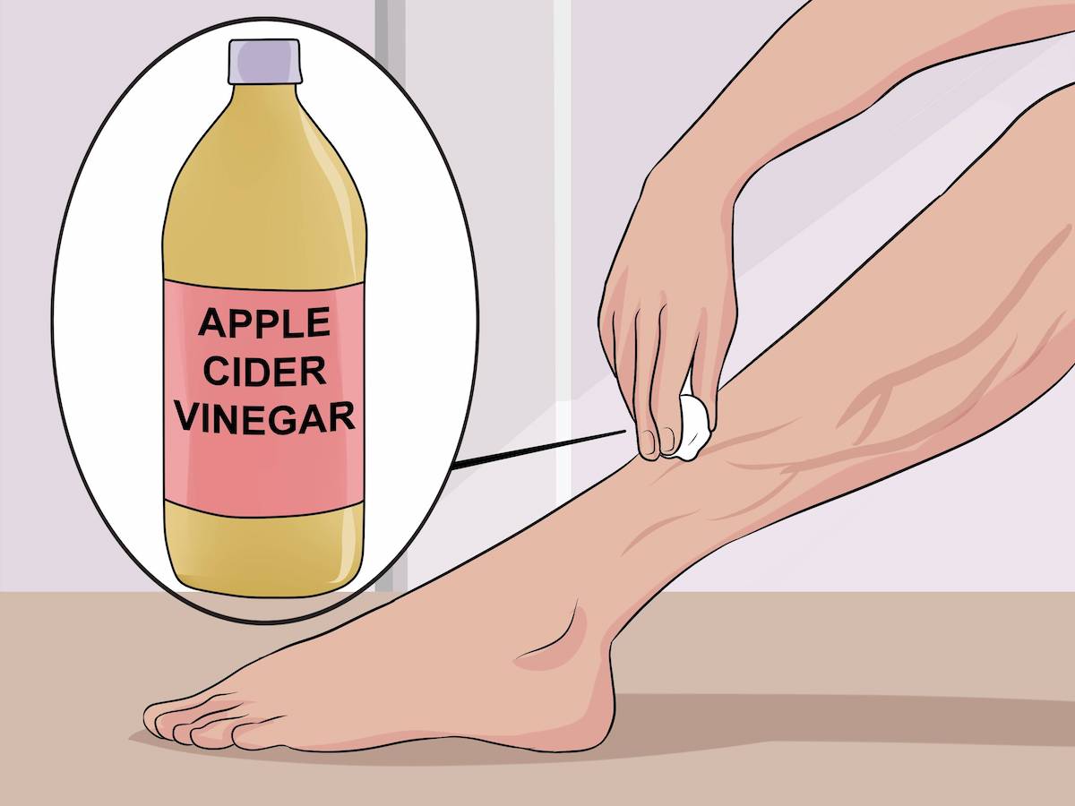 Get-Rid-of-Varicose-Veins