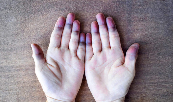 Pass auf: Deine Hände warnen dich vor diesen Gesundheitsproblemen