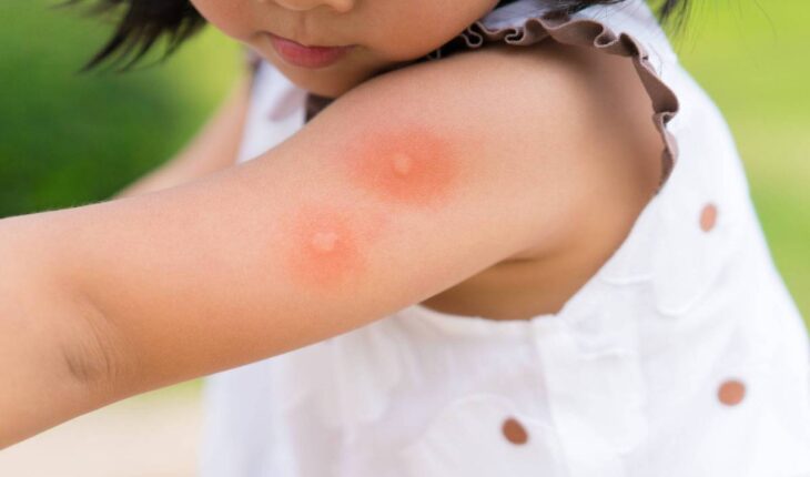 Muggenbult? 7 tips tegen die vervelende jeuk