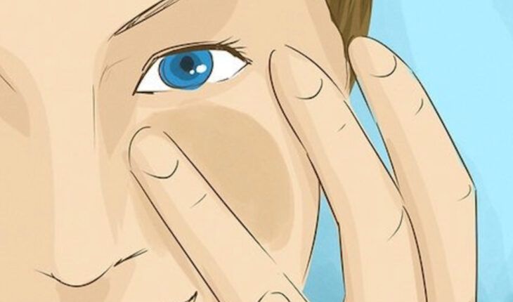 Dermatologen verraten, wie man Augenringe loswird