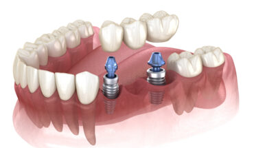 Dental Implants: Why You Need Them, Costs & Types