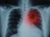 Lung Cancer: Warning Signs, Stages & Treatments Options