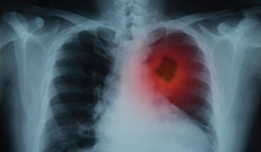 Lung Cancer: Warning Signs, Stages & Treatments Options