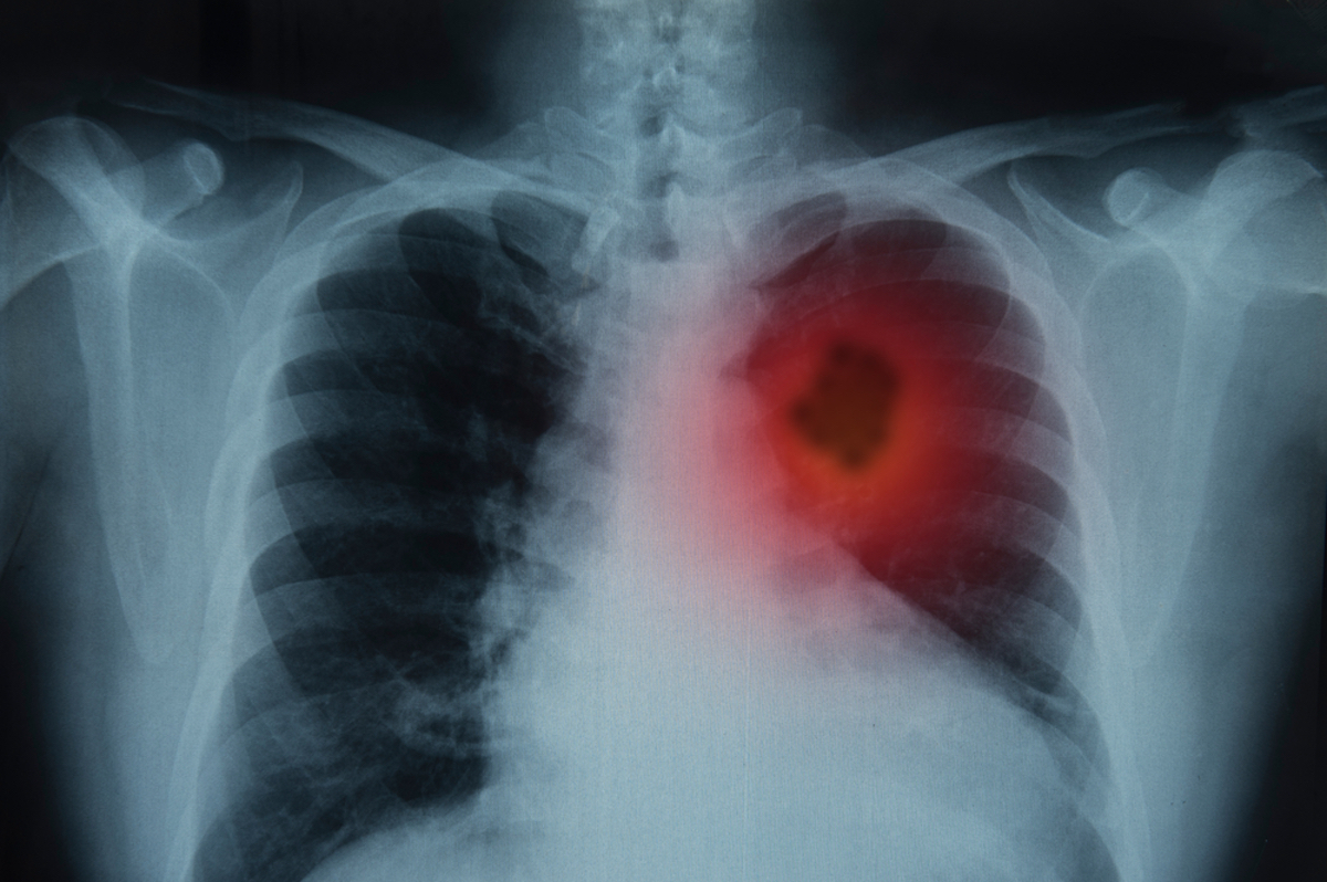 Lung cancer or pneumonia. X-ray image of patient's lungs to lung tumor. 