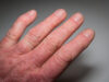 Psoriatic Arthritis (PsA): Symptoms, Causes & Treatment Options