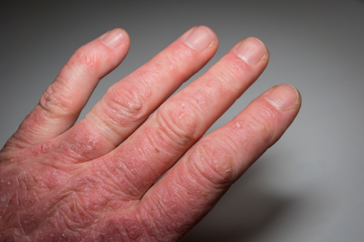 Hand of a psoriasis patient close-up. Psoriatic arthritis. Joint deformation and inflammation on the skin. Photo with dark vignetting.Soft focus.