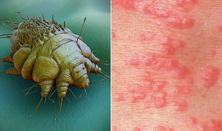 Scabies: Causes, Rash Signs & Treatment Options