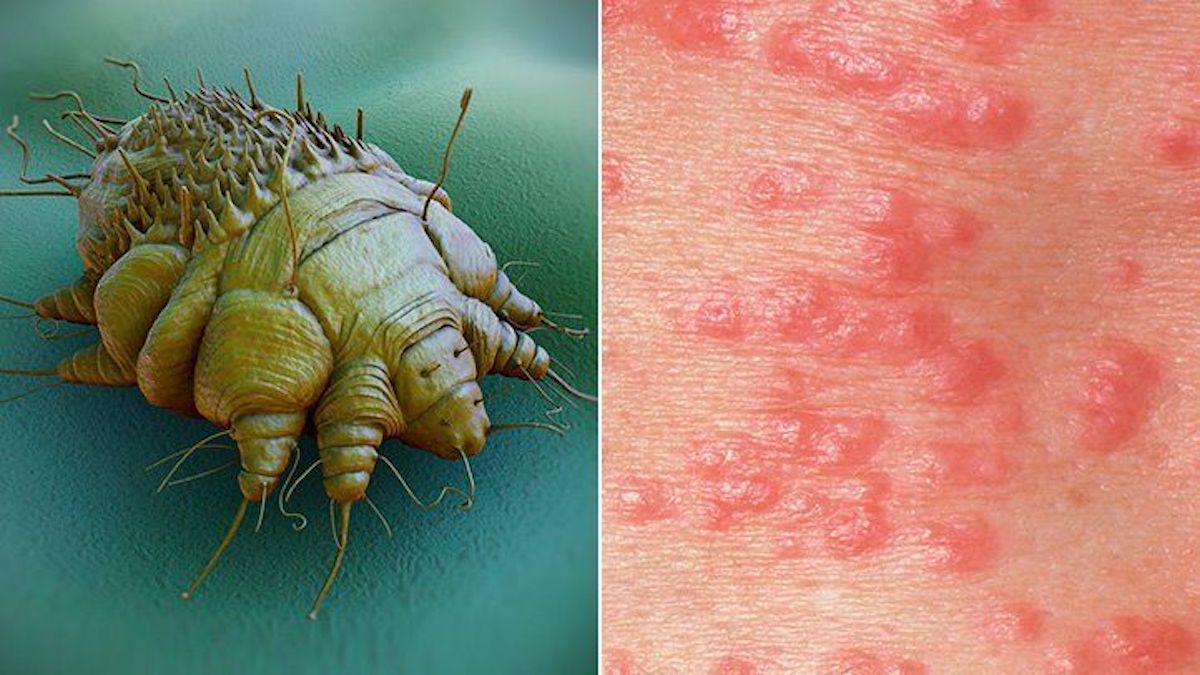 can mites or scabies come from a mattress