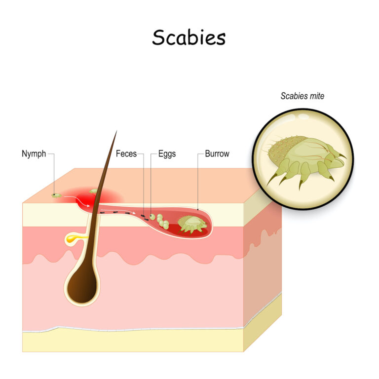 scabies-causes-rash-signs-treatment-options