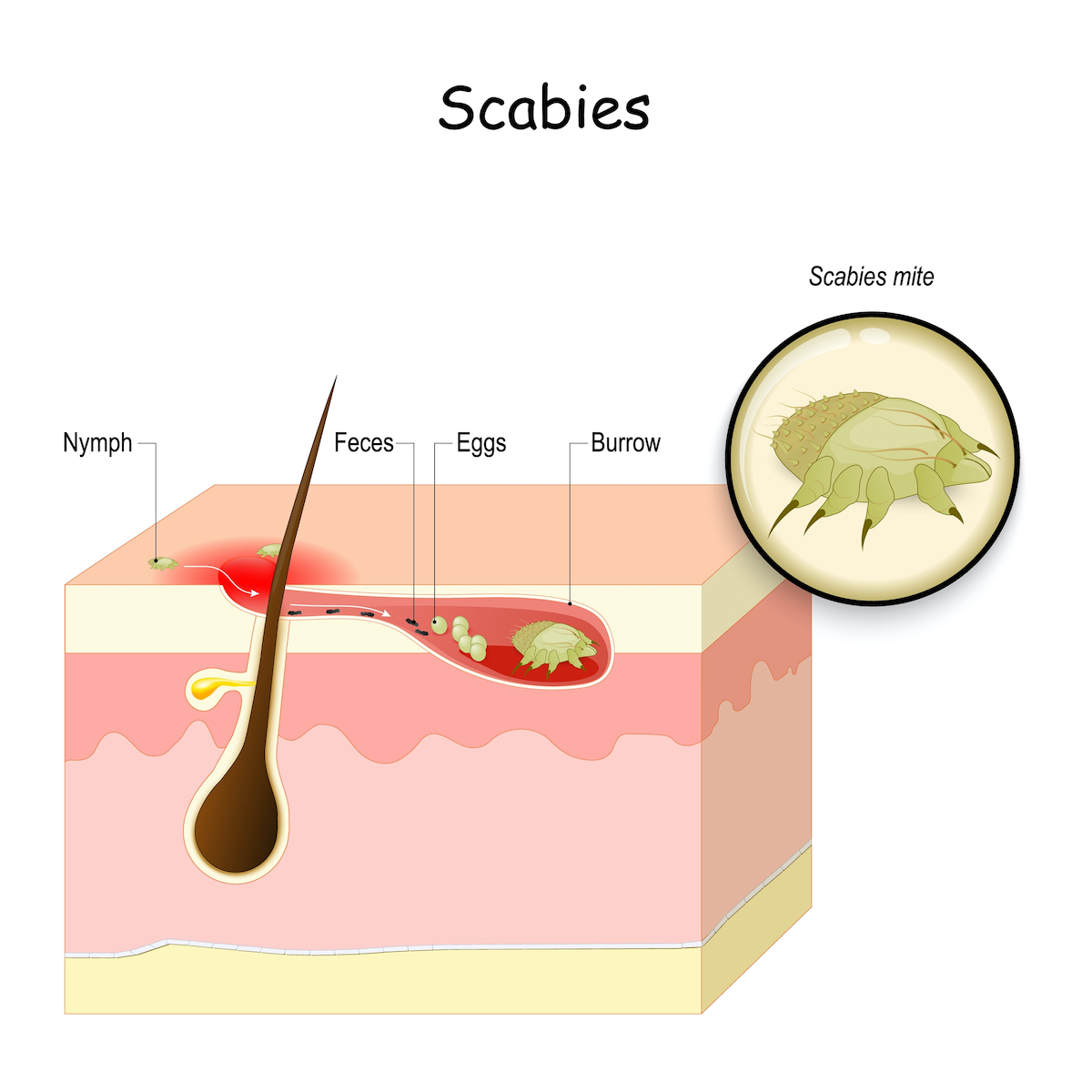 Scabies. seven-year itch is a contagious skin infestation by the mite Sarcoptes scabiei. Skin with eggs and mite in a burrow. Close-up of Scabies mite.