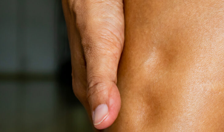 Edema: Types, Causes, Signs & Treatment