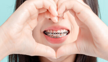 Dental Braces: Types & How Much Do They Cost