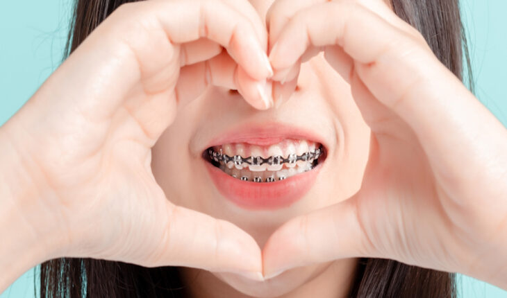 Dental Braces: Types & How Much Do They Cost