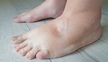 This Is What You Should Know About Edema