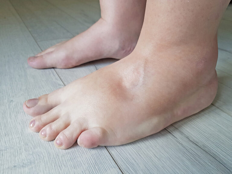 Edema: Types, Causes, Signs & Treatment Options