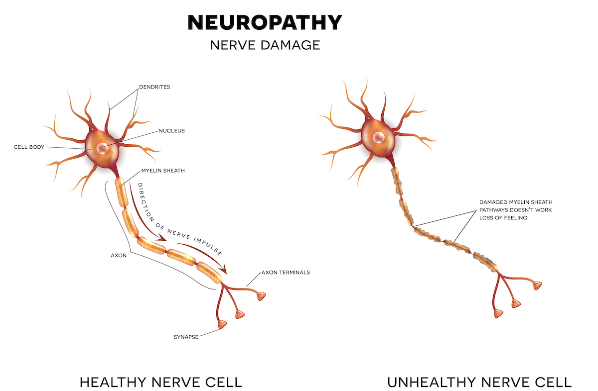 Neuropathy which is the damage of nerves, this can be caused by Diabetes.
