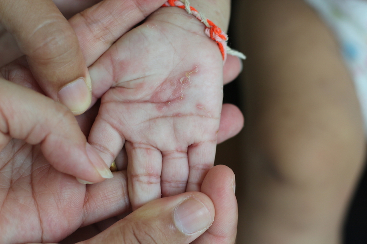 A skin lesion on 4-month-old baby right hand showed scabies infection described as small papules, vesicles and burrows reddish bumps or blisters weeping like skin, very itchy