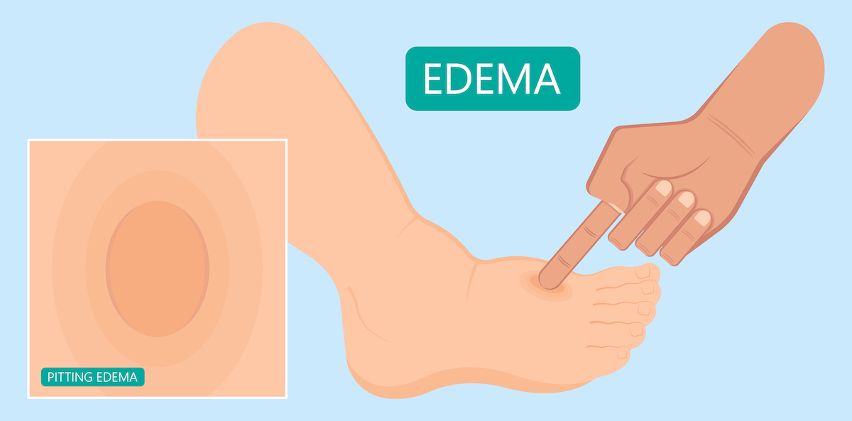Edema swelling under the skin that affect with ankles and legs cirrhosis puffiness Stretched shiny dimple pits pressed deep vein thrombosis