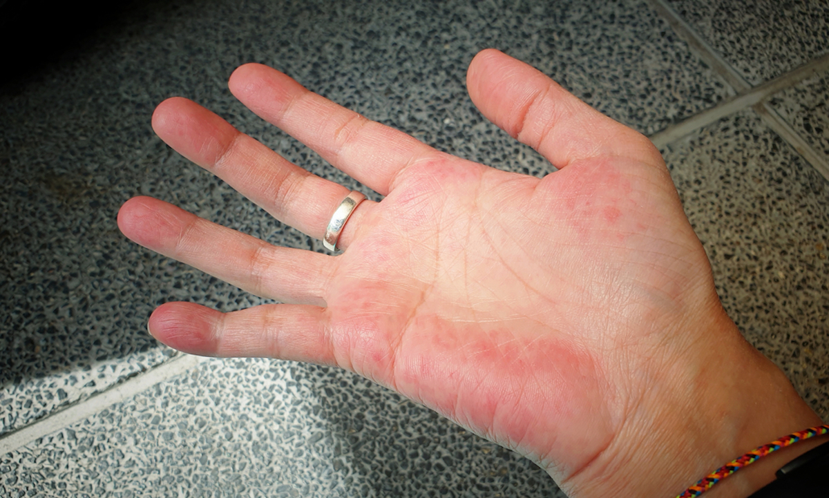 Unusual red on the palm hand from SLE symptom effect blood system. Systemic lupus erythematosus (SLE) is a chronic disease caused by self-immunity which causes affects the organs and blood system. Skin rash on hand