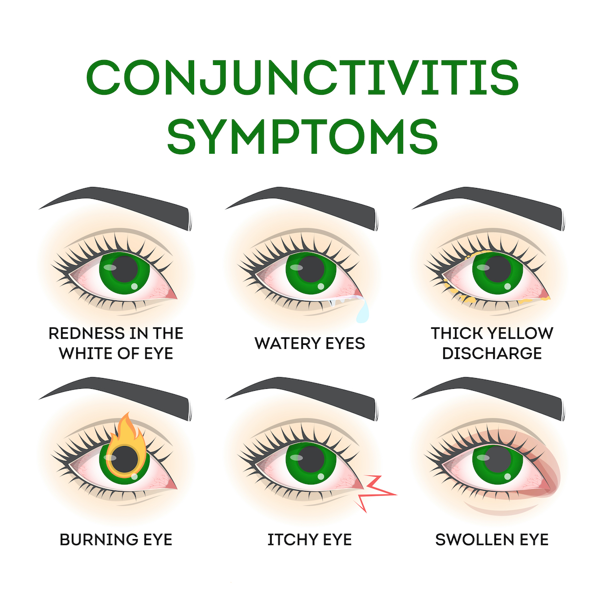 Conjunctivitis symptoms. Pink eye disease, infection and allergy. Problem with vision. Isolated vector illustration in cartoon style