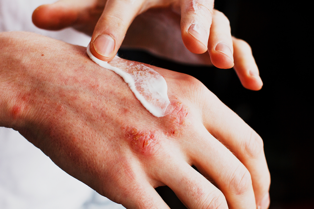 Eczema on the hands. The man applying ointment, creams in the treatment of eczema, psoriasis and other skin diseases. Concept of skin problems
