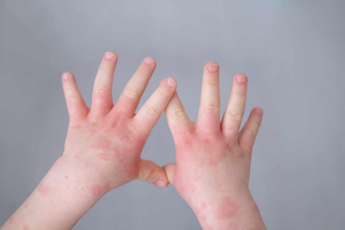 close up kids hand with allergic rash or eczema. severe allergic reaction, atopic skin
