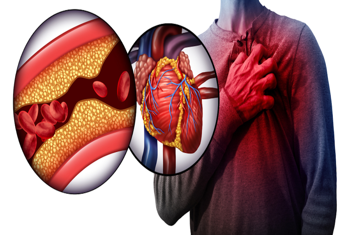 Myocardial infarction as the person suffering from a heart attack due to clogged coronary artery as a cardiac emergency symbol with 3D illustration elements.