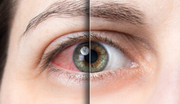 Pink Eye (Conjunctivitis): Causes, Symptoms & Treatment Options