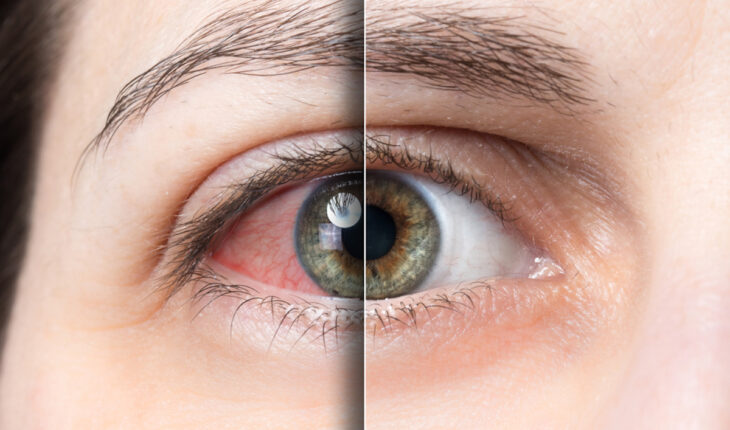 Pink Eye (Conjunctivitis): Causes, Symptoms & Treatment Options