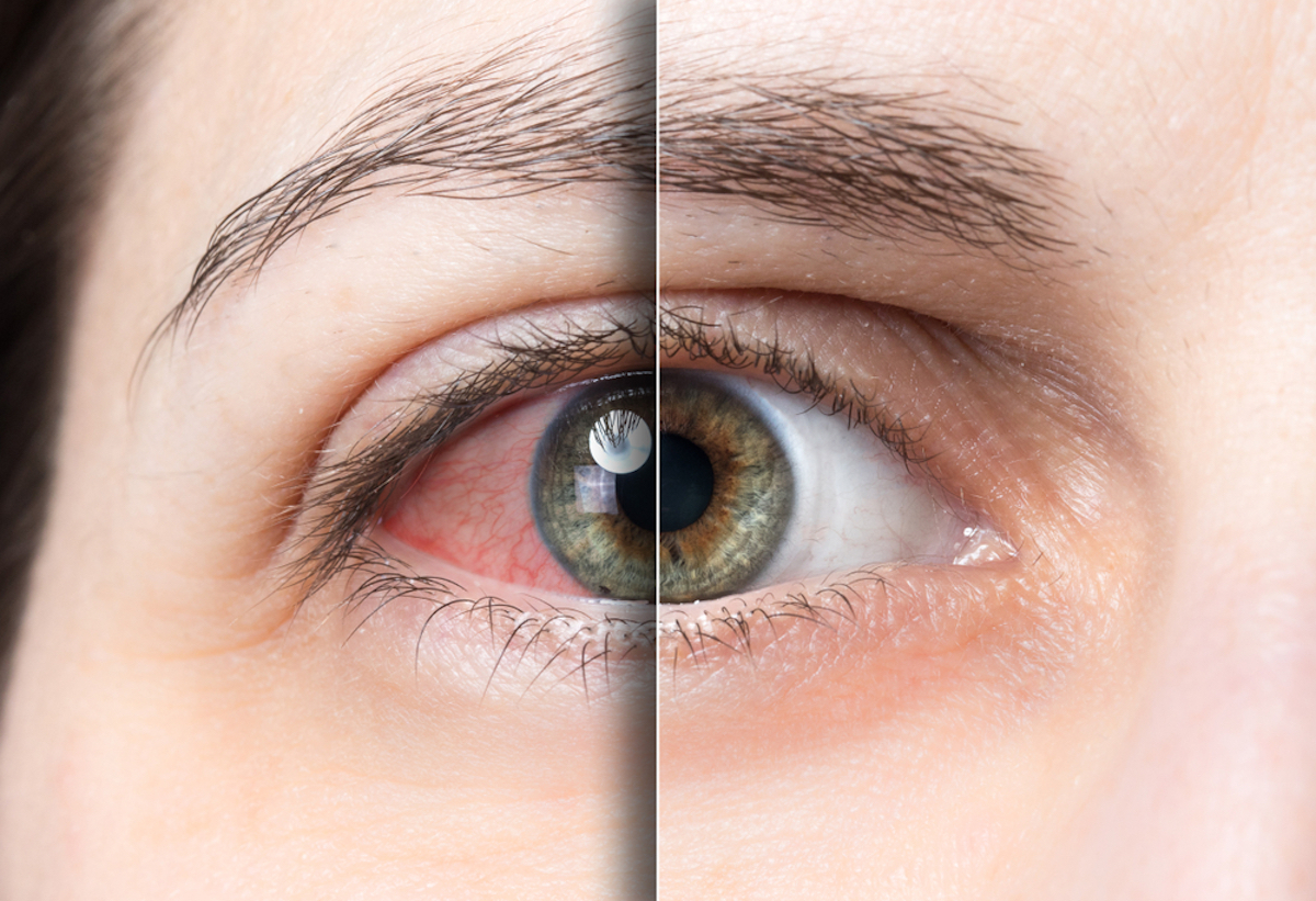Red eyes before and after treatment