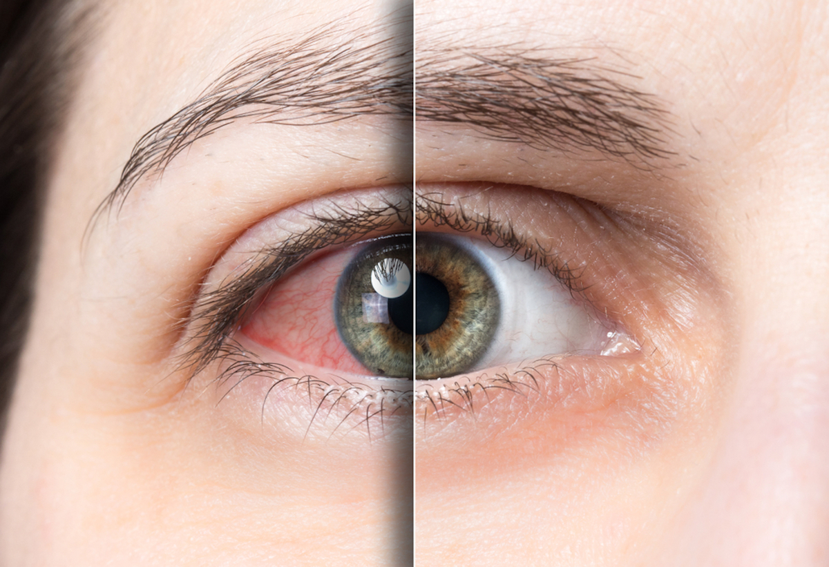 Red Eyes Before and After Treatment