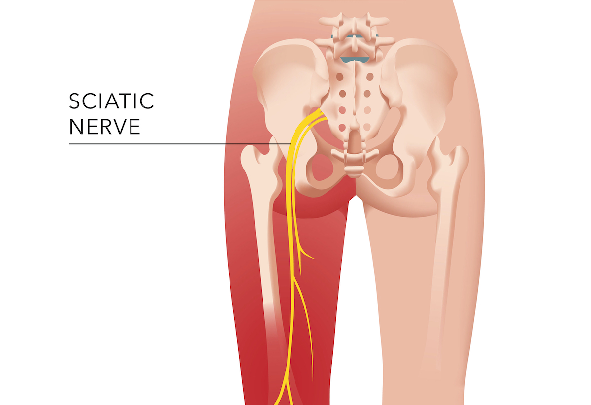 Sciatica - close-up of sciatic nerve and radiant pain pathway