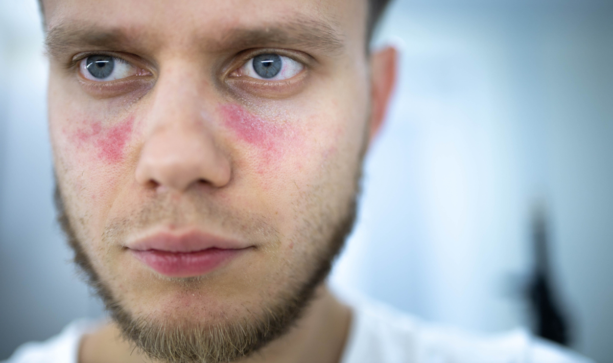 age spots of redness on the face, a young man is ill systemic lupus erythematosus