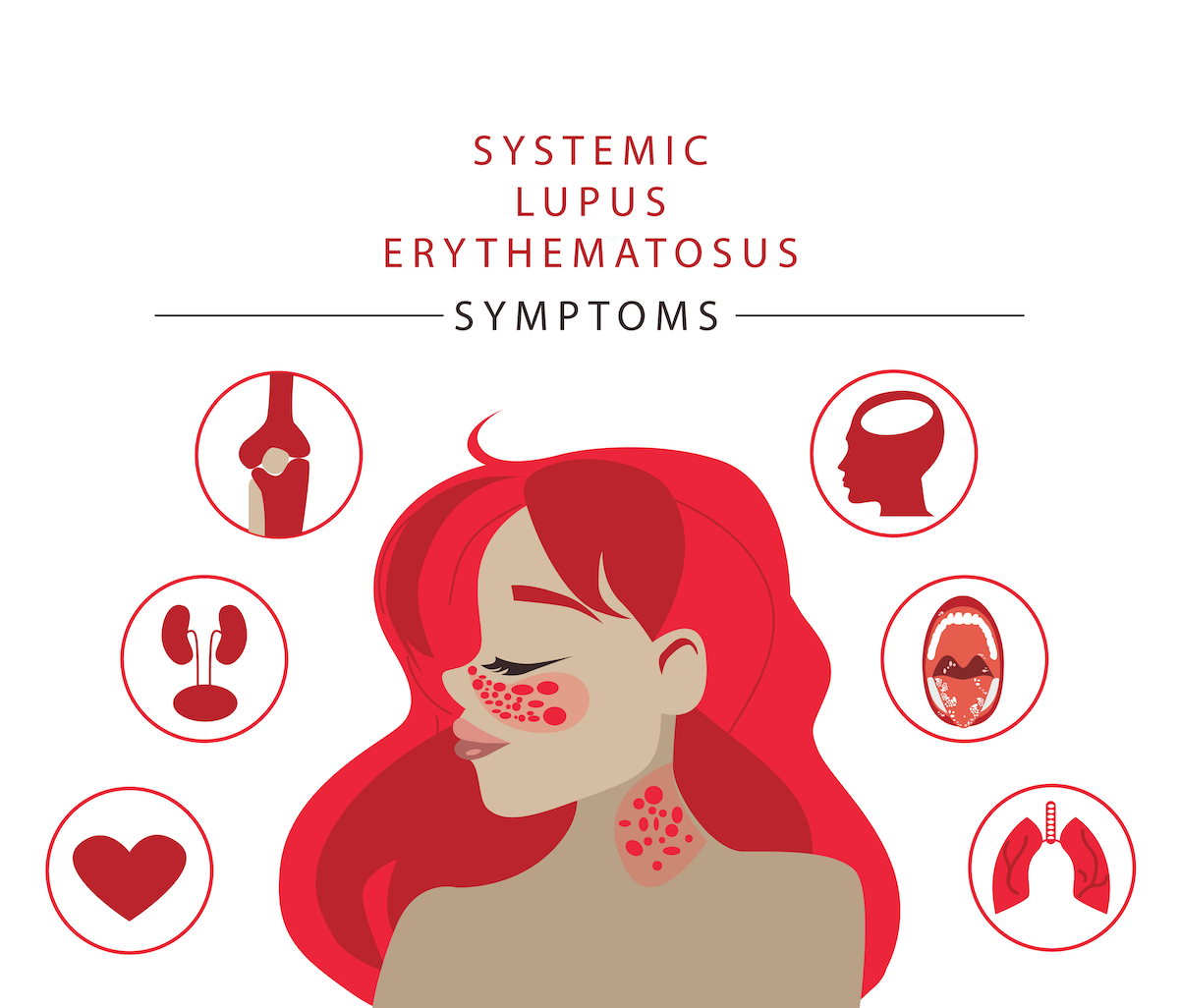 Systemic lupus erythematosus. A woman with a red spot on her face in the shape of a butterfly. Illustration of the main symptom of SLE. common lupus symptoms logo icon. Vector illustration of CARTOON