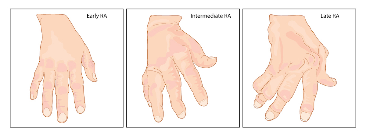 A hand with early, intermediate and late rheumatoid arthritis with typical swelling of the joints and deformation of the fingers and knuckles