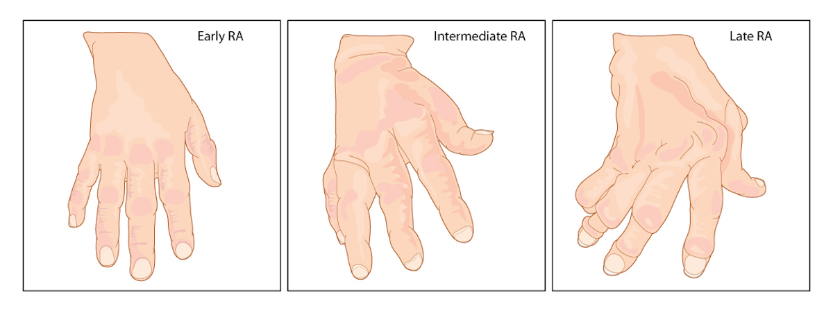 a Hand with Early Intermediate and Late Rheumatoid Arthritis with Typical Swelling of the Joints and Deformation of the Fingers and Knuckles