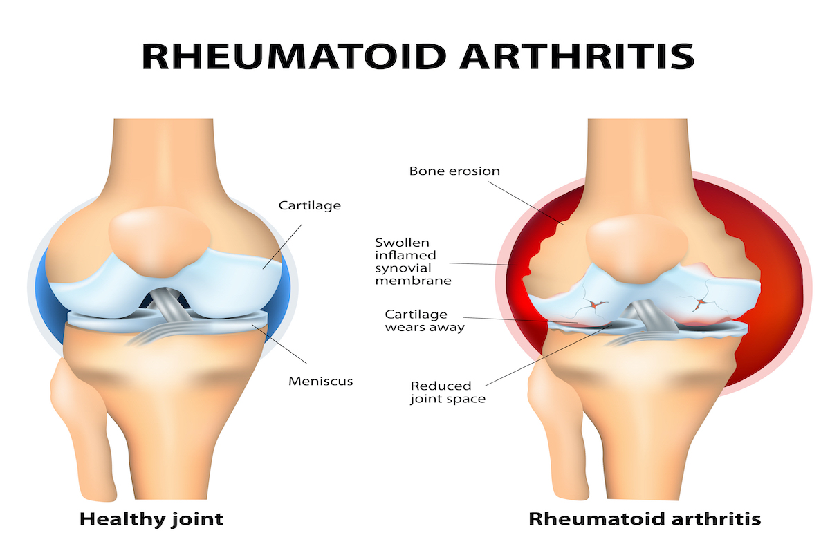 Rheumatoid arthritis (RA) is an inflammatory form of arthritis that usually affects knees. the autoimmune disease. The body's immune system mistakenly attacks healthy tissue.