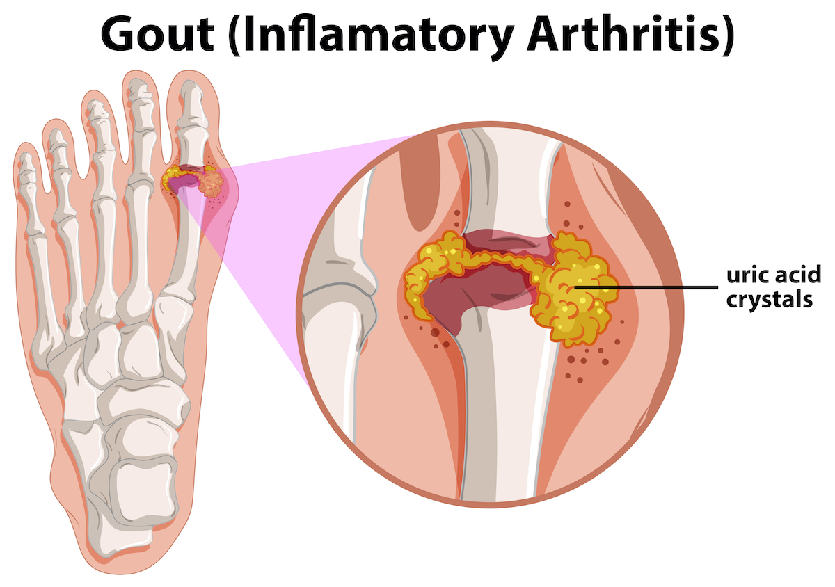 Diagram showing gout in human foot illustration
