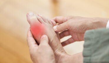 Gout: Causes, Symptoms & Treatment Options