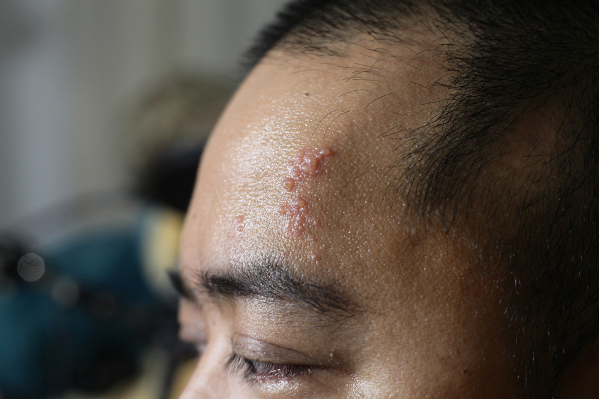 a Picture of Blisters on the Face Due to Shingles