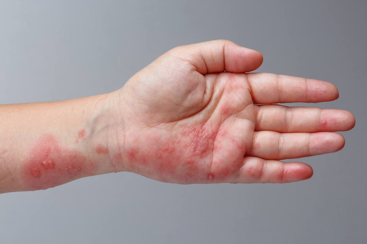 Shingles Zoster or Herpes Zoster Symptoms on Arm