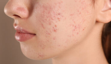 What Everyone Should Know About Acne