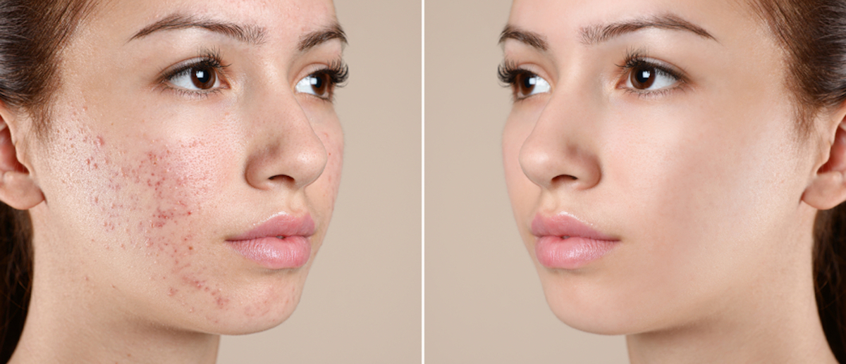 Teenage girl before and after acne treatment on beige background 