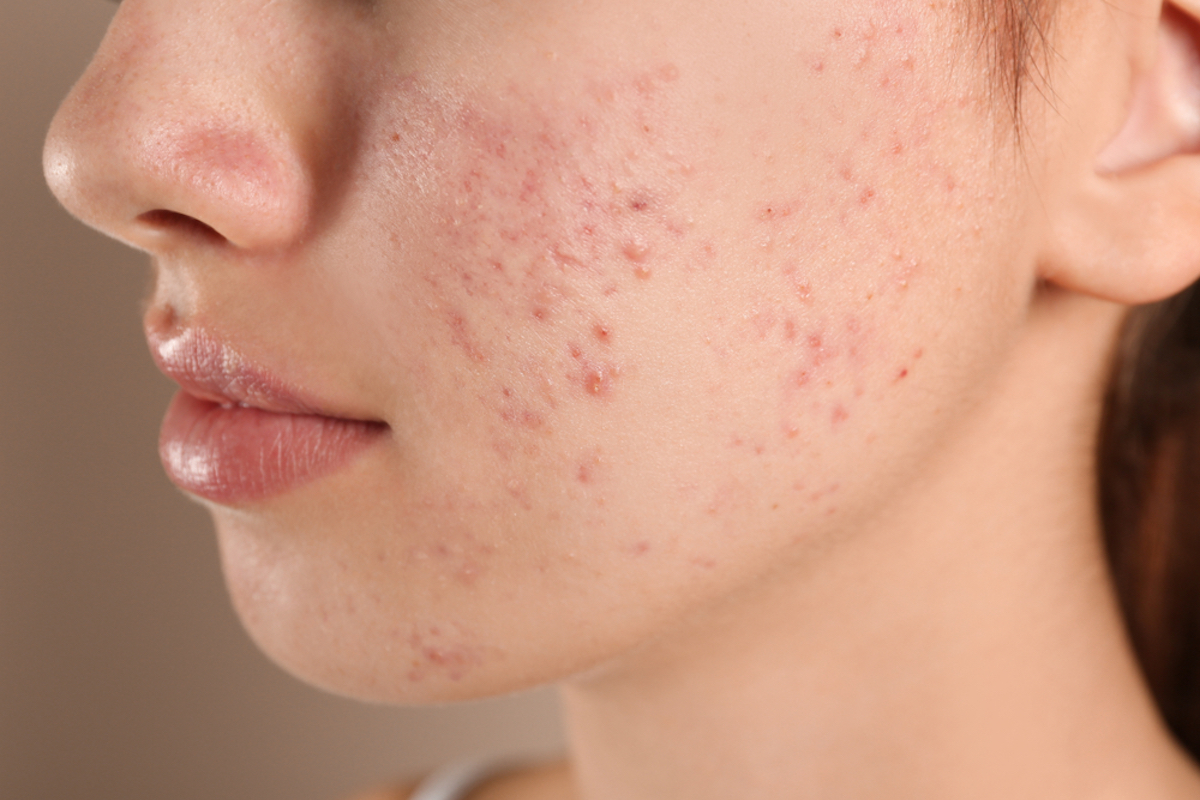 Teenage girl with acne problem on beige background, close-up 
