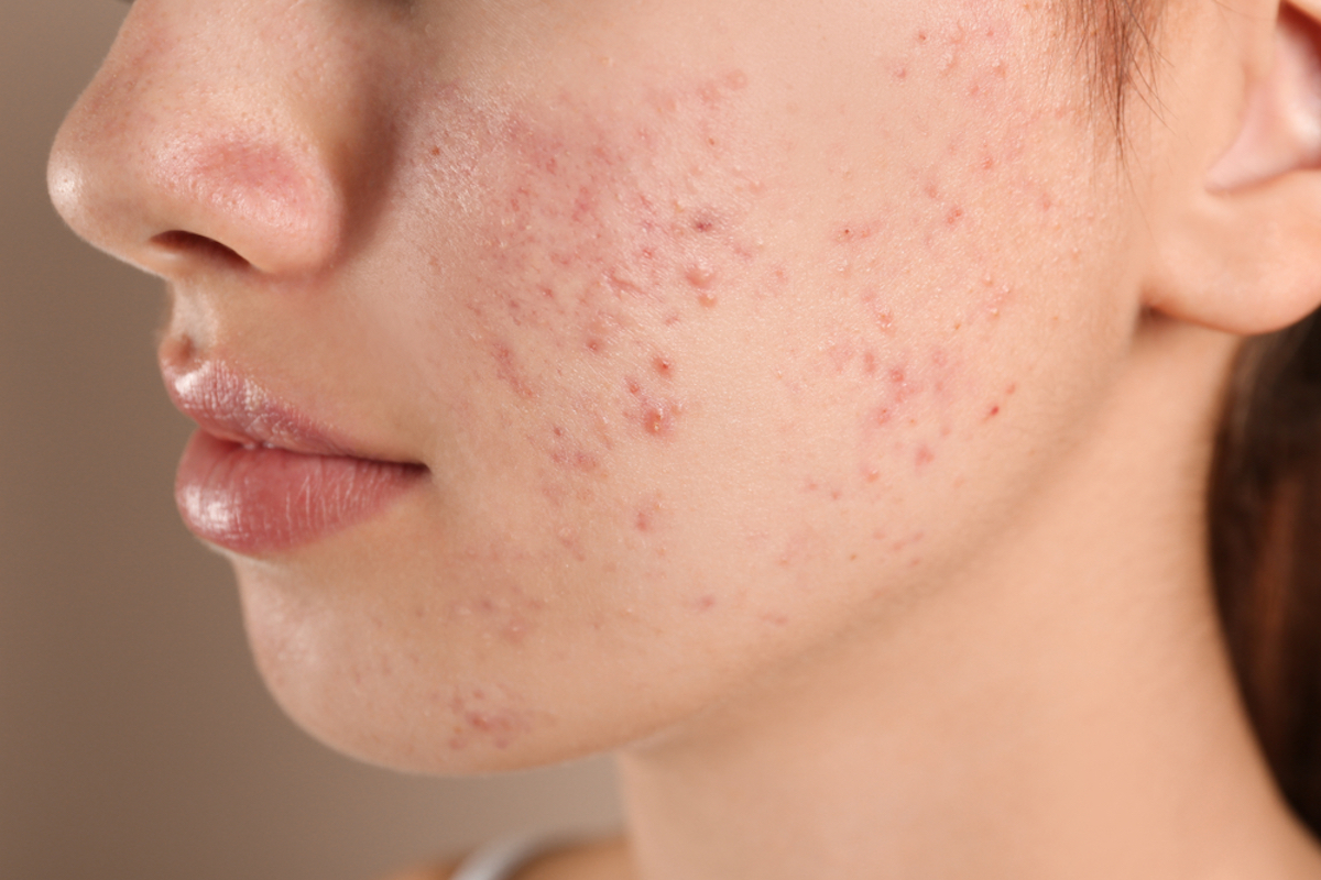 Teenage Girl with Acne Problem on Beige Background Close up