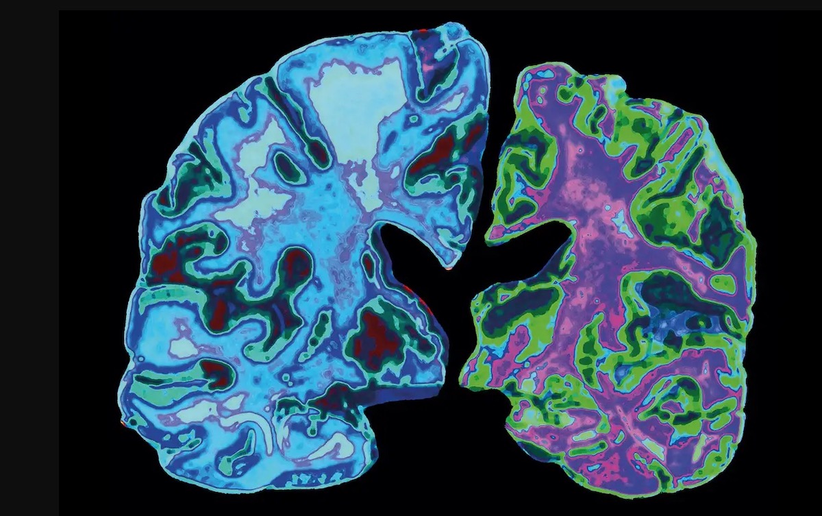 COPD: Causes, Symptoms & Treatment