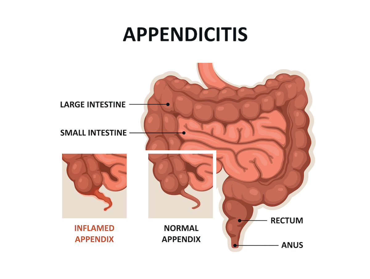 Appendicitis is inflammation of the appendix