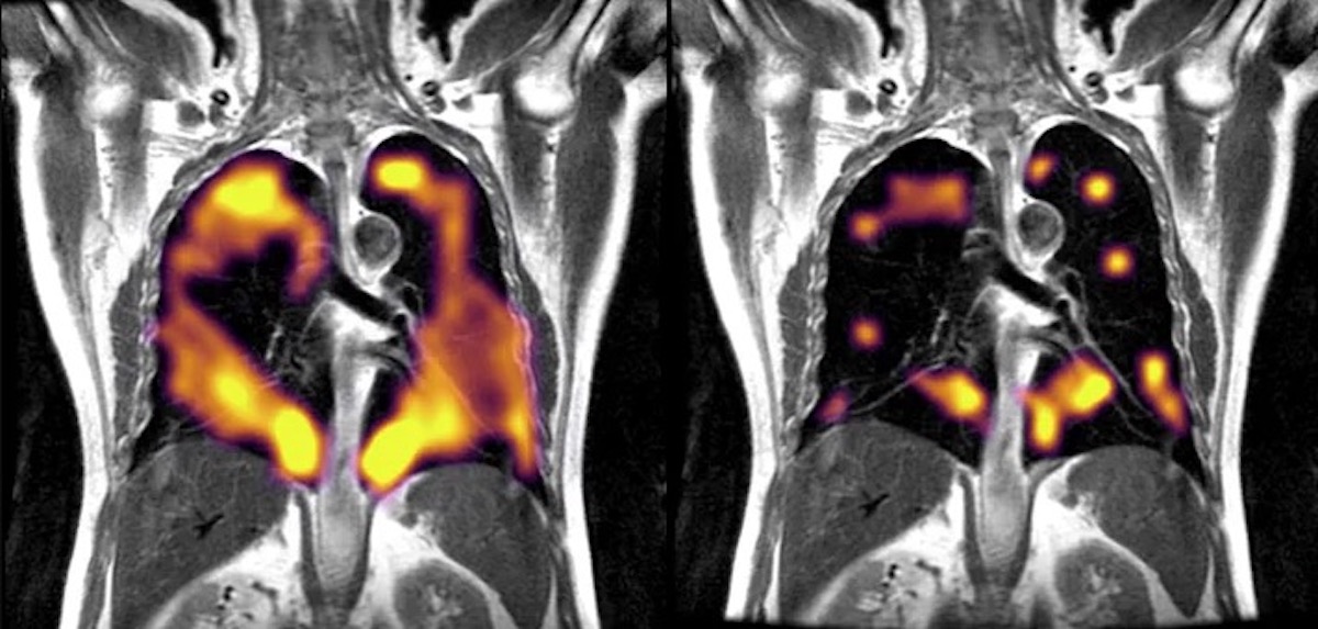 COPD: Causes, Symptoms & Treatment