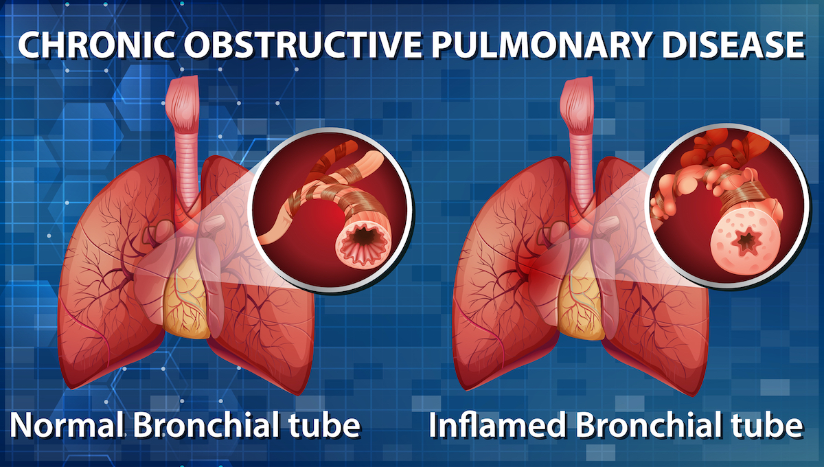 COPD illustration
