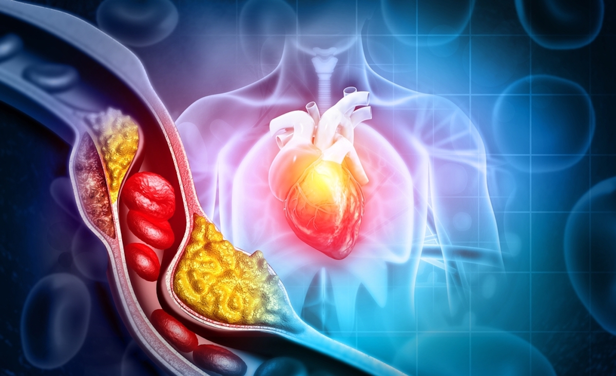 Cholesterol Blocked Artery with Heart 3d Illustration